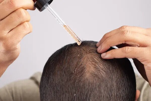 آیا مصرف برخی داروها باعث ریزش مو می شود؟